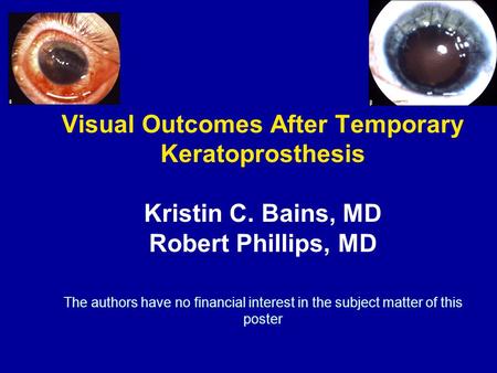 Visual Outcomes After Temporary Keratoprosthesis Kristin C. Bains, MD Robert Phillips, MD The authors have no financial interest in the subject matter.