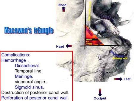 Zygomatic arch Mastoid tip Nose Feet Occiput Emissary vein Macewe n’s triangle Complications: Hemorrhage. Dissectional. Temporal line. Meninge. sinodural.