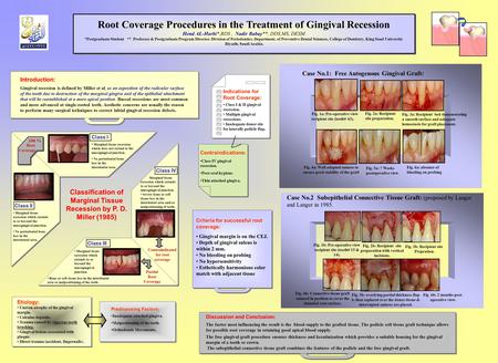 Root Coverage Procedures in the Treatment of Gingival Recession