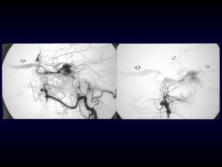 Dural Arteriovenous Fistulae Static or Dynamic? Cognard et al –seven patients with documented worsening of venous drainage –aggressive natural history.