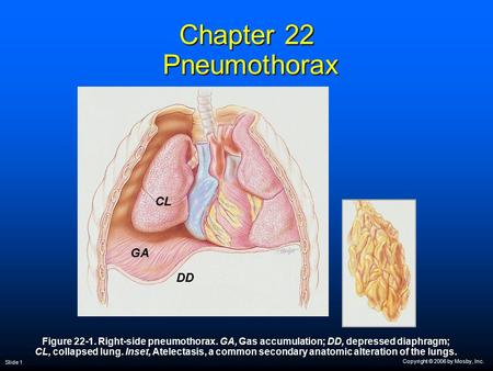 Chapter 22 Pneumothorax CL GA DD