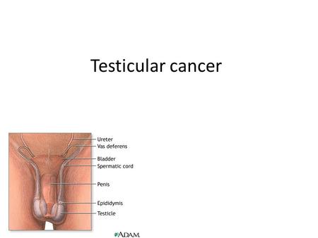 Testicular cancer.