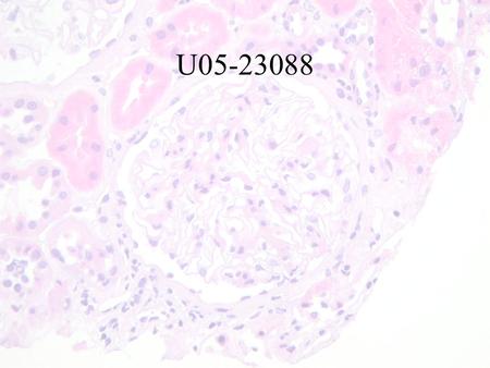 U05-23088. 19 yo African female student (here since 2001) Medical exam for Immigration notable for protein-uria and Hematuria. Serum Creatinine 81umol/L.