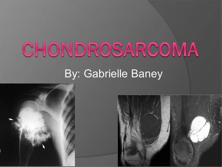 By: Gabrielle Baney. What is Chondrosarcoma?  Chondrosarcoma is a malignant neoplasm of cartilage cells. It invades the cartilage resulting in broken.