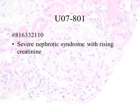U07-801 #816332110 Severe nephrotic syndrome with rising creatinine.