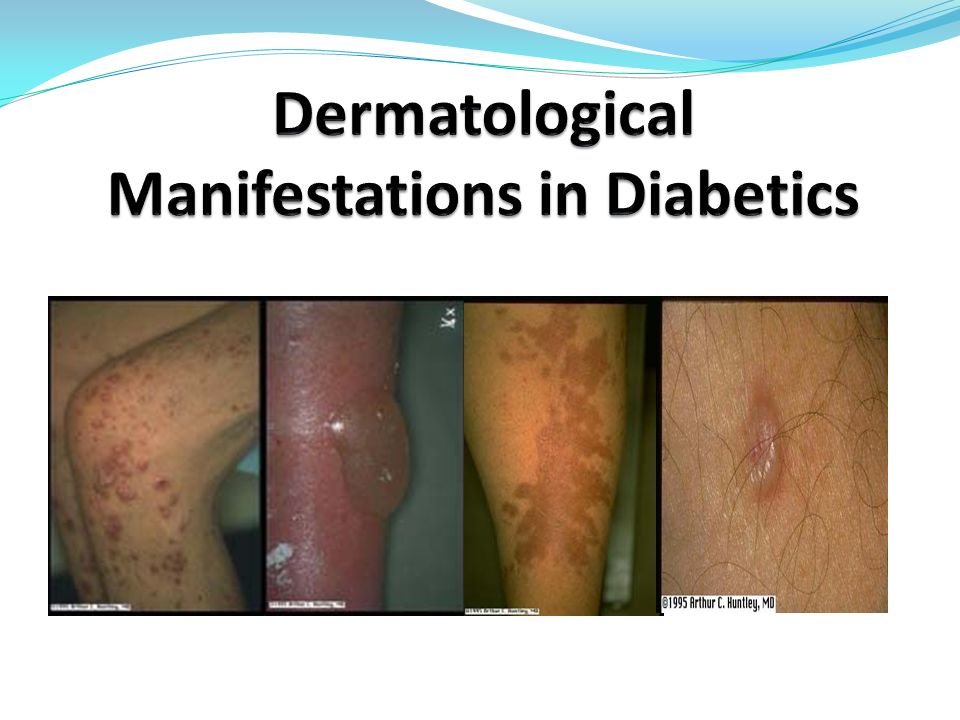diabetic skin lesion)