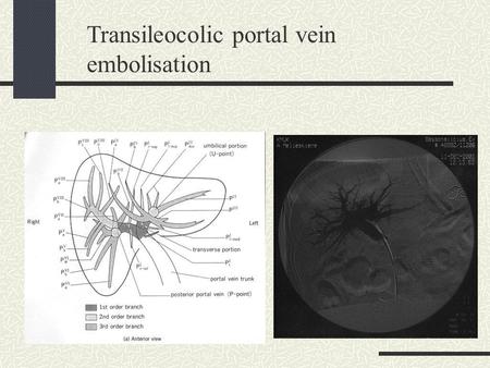 Transileocolic portal vein embolisation