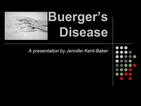 Buerger’s Disease A presentation by Jennifer Kent-Baker.