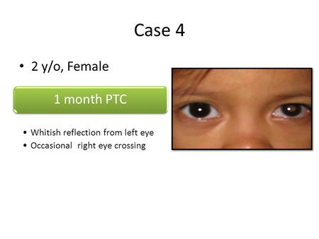 Case 4 2 y/o, Female 1 month PTC Whitish reflection from left eye Occasional right eye crossing.