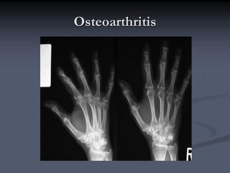 Osteoarthritis. Knee osteoarthritis Osteoarthritis.