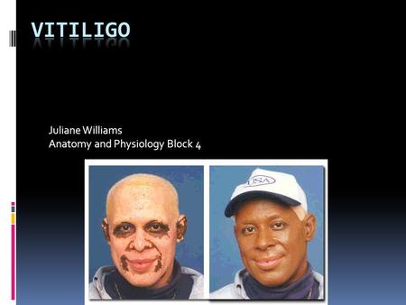 Juliane Williams Anatomy and Physiology Block 4. What is Vitiligo? It is a pigmentation disorder in which melanocytes in the skin are destroyed.