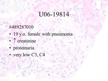 U06-19814 #489287010 19 y.o. female with pneumonia  creatinine proteinuria very low C3, C4.