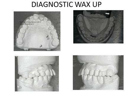 DIAGNOSTIC WAX UP 17.0mm 5.5mm Interocc space=10mm Open bite=4mm Central incisaa gingival=12mm Mesial-distal=8.5mm.