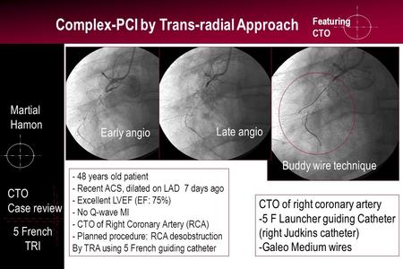 Featuring CTO Complex-PCI by Trans-radial Approach CTO Case review 5 French TRI CTO of right coronary artery -5 F Launcher guiding Catheter (right Judkins.