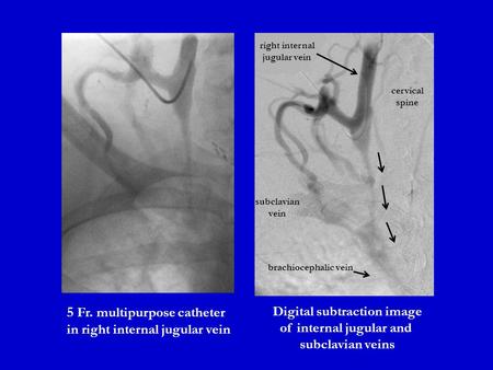 5 Fr. multipurpose catheter in right internal jugular vein Digital subtraction image of internal jugular and subclavian veins cervical spine brachiocephalic.