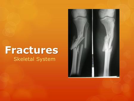 Fractures Skeletal System. Simple Fracture  Complete break between bones.