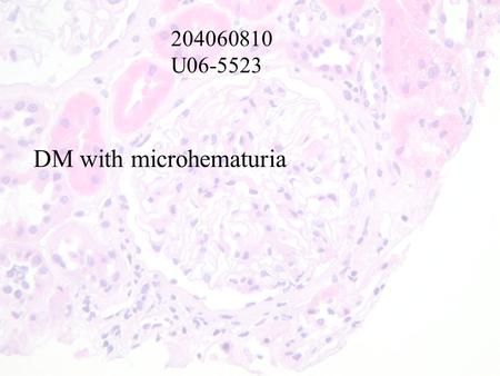 204060810 U06-5523 DM with microhematuria. U06-552344 yr married female,mother of two children, referred to the Renal clinic by family physician on january.