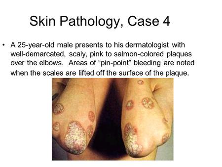 Skin Pathology, Case 4 A 25-year-old male presents to his dermatologist with well-demarcated, scaly, pink to salmon-colored plaques over the elbows. Areas.