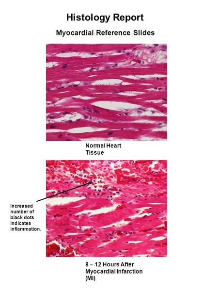 Histology Report Myocardial Reference Slides 8 – 12 Hours After Myocardial Infarction (MI) Normal Heart Tissue Increased number of black dots indicates.