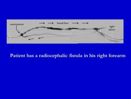 Patient has a radiocephalic fistula in his right forearm right elbow blood flow anastomosis.