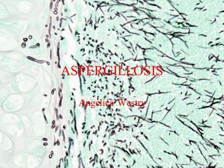 ASPERGILLOSIS Angelica Westry. Symptoms A fungus ball in the lungs may cause no symptoms and may be discovered only with a chest x-ray. Or it may cause.