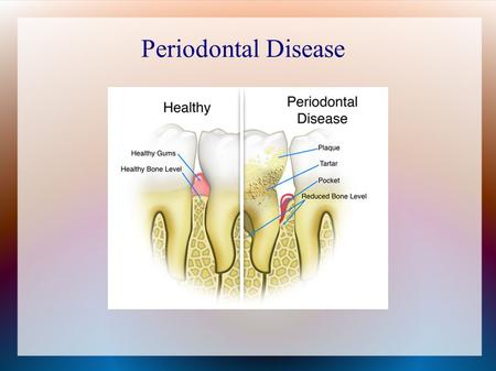 Periodontal Disease. Patient Profile Patient is a 68 year old male Health History  Presents with High Blood pressure  Medications: allertec and ¼ grain.
