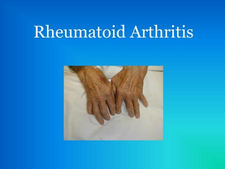 Rheumatoid Arthritis.