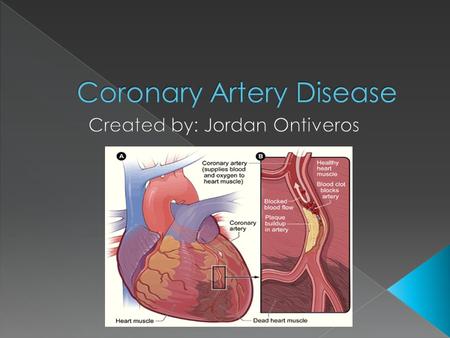  This disease Narrows the blood vessels that carry oxygen-rich blood to your heart. This happens because of plaque build up in the vessels.  The coronary.