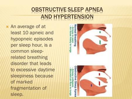  An average of at least 10 apneic and hypopneic episodes per sleep hour, is a common sleep- related breathing disorder that leads to excessive daytime.