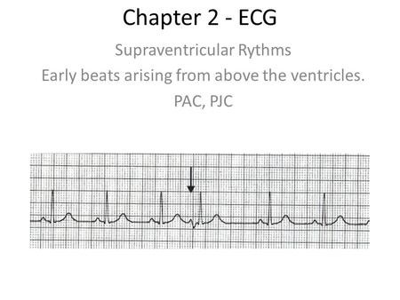Chapter 2 - ECG Supraventricular Rythms Early beats arising from above the ventricles. PAC, PJC.