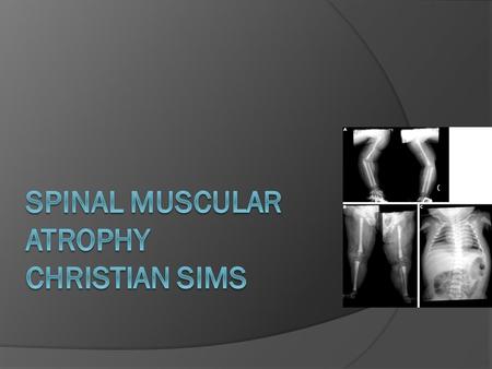 Spinal Muscular Atrophy CHRISTIAN SIMS