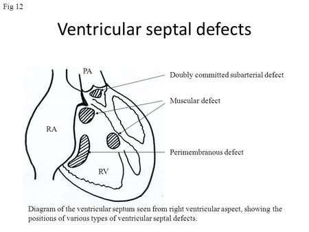 Ventricular septal defects