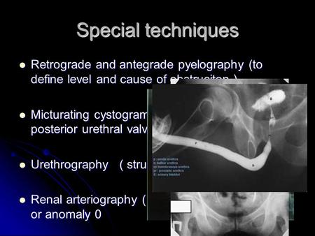 Special techniques Retrograde and antegrade pyelography (to define level and cause of obstruciton ) Micturating cystogram ( mainly in children for posterior.