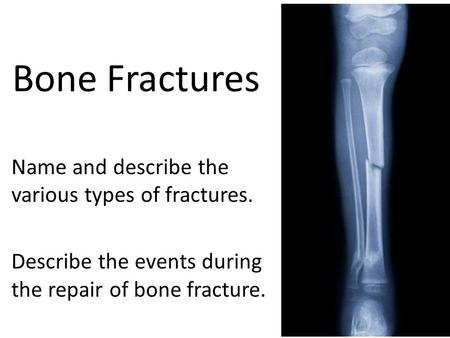 Bone Fractures Name and describe the various types of fractures.