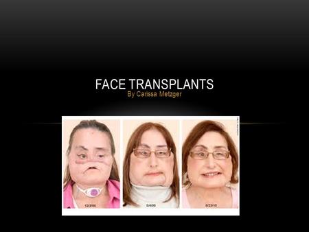 By Carissa Metzger FACE TRANSPLANTS. WHO CAN RECEIVE A FACE TRANSPLANT? Most face transplants deal with people who have a bone disease or an accident.