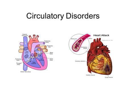 Circulatory Disorders. Heart Attack A heart attack occurs when the blood supply to part of the heart muscle is severely reduced or stopped. The reduction.
