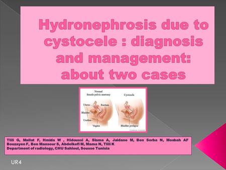 Hydronephrosis due to cystocele : diagnosis and management: about two cases Tlili G, Mallat F, Hmida W , Hidoussi A, Slama A, Jaidane M, Ben Sorba N, Mosbah.