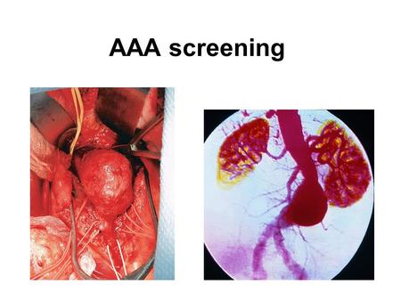 AAA screening. AAA – 1.5x normal diameter/>3cm diameter 6000 deaths/year – England + Wales 2% all deaths men 65+ 4% men 65-74 have AAA.