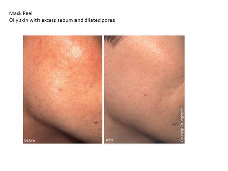 Before After Courtesy Dr. Vigneron Mask Peel Oily skin with excess sebum and dilated pores.