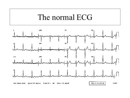 The normal ECG. Normal sinus rhythm –Each p wave followed by a QRS –Normal P waves –P wave rate 60-100bpm.