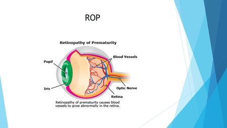 ROP. What is ROP  Retinopathy of prematurity (ROP) is a potentially blinding eye disorder that primarily affects premature infants weighing about 2¾.