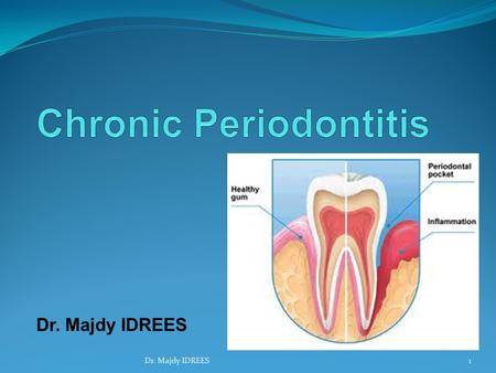 Dr. Majdy IDREES 1. Gingivitis Periodontitis 2Dr. Majdy IDREES.