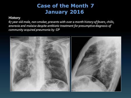History : 67 year old male, non smoker, presents with over a month history of fevers, chills, anorexia and malaise despite antibiotic treatment for presumptive.