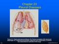 Copyright © 2006 by Mosby, Inc. Slide 1 Chapter 23 Pleural Diseases Figure 23-1. Right-sided pleural effusion. FA, Fluid accumulation; DD, depressed diaphragm;