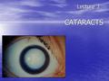 Lecture 3 CATARACTS Lecture 3 CATARACTS. Classification of cataracts: Classification of cataracts: By age: congenital, juvenile, age-related (senile)