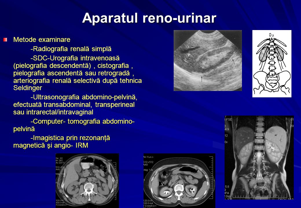 Aparatul reno-urinar Metode examinare -Radiografia renală simplă  -SDC-Urografia intravenoasă (pielografia descendentă), cistografia,  pielografia ascendentă. - ppt download