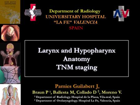 Pamies Guilabert J, Braun P 1, Ballesta M, Collado D 2, Moreno V. 1 Department of Radiology. Hospital de la Plana, Vila-real, Spain 2 Department of Otolaryngology.