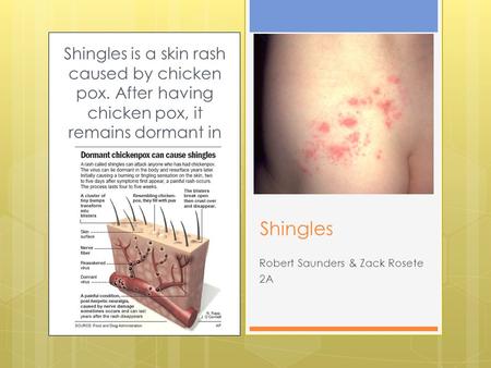 Shingles is a skin rash caused by chicken pox