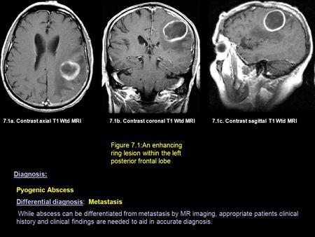 7.1a. Contrast axial T1 Wtd MRI7.1b. Contrast coronal T1 Wtd MRI Figure 7.1:An enhancing ring lesion within the left posterior frontal lobe 7.1c. Contrast.