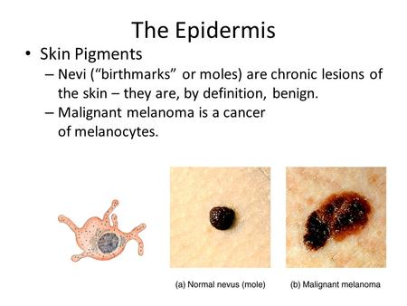 The Epidermis Skin Pigments – Nevi (“birthmarks” or moles) are chronic lesions of the skin – they are, by definition, benign. – Malignant melanoma is a.